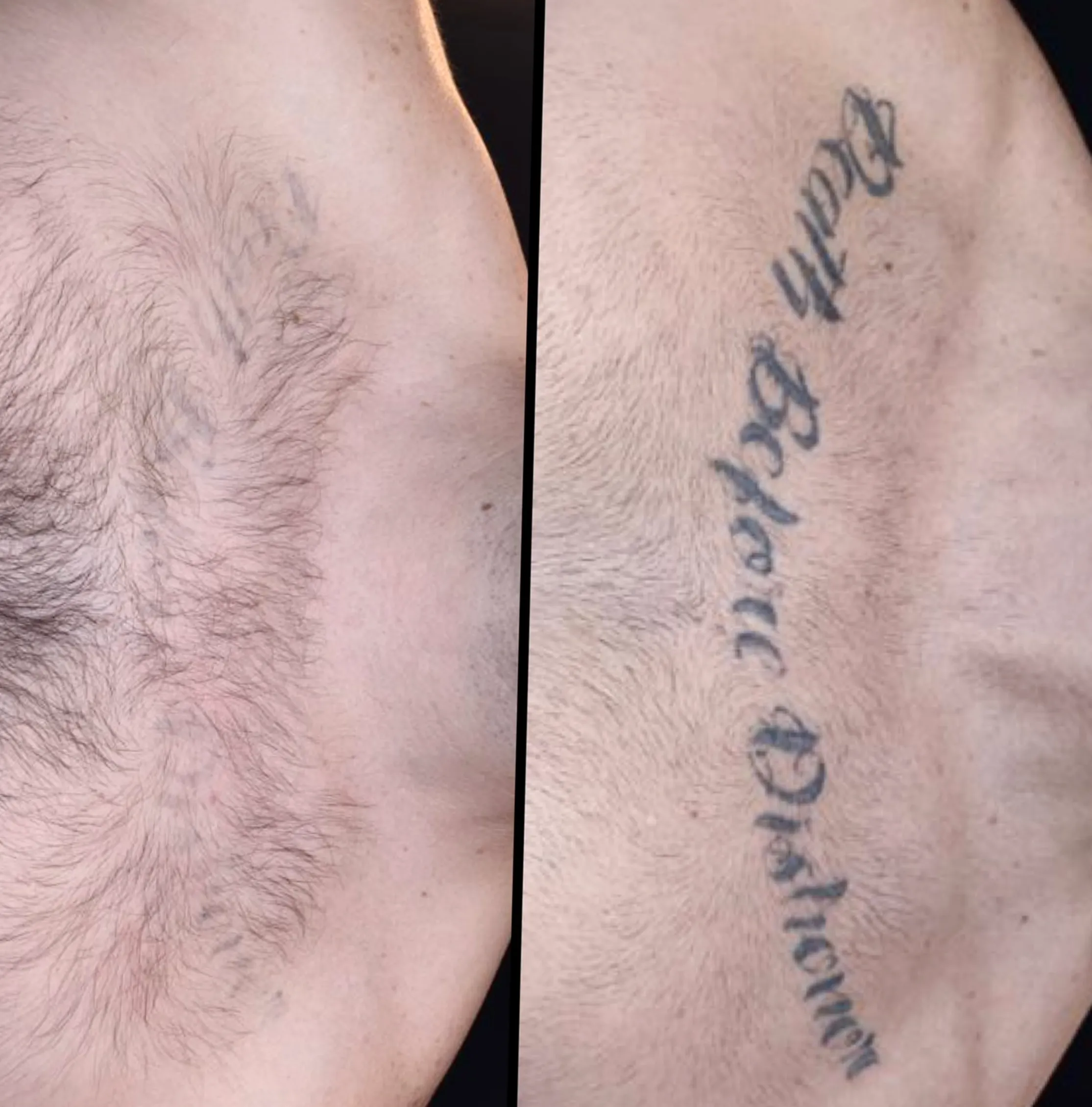 safe tattoo removal methods