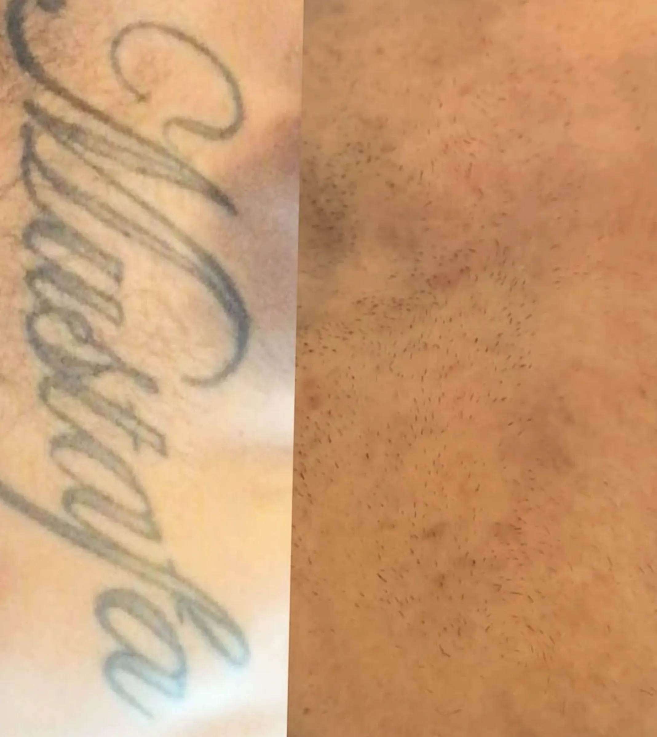 laser tattoo removal Melbourne