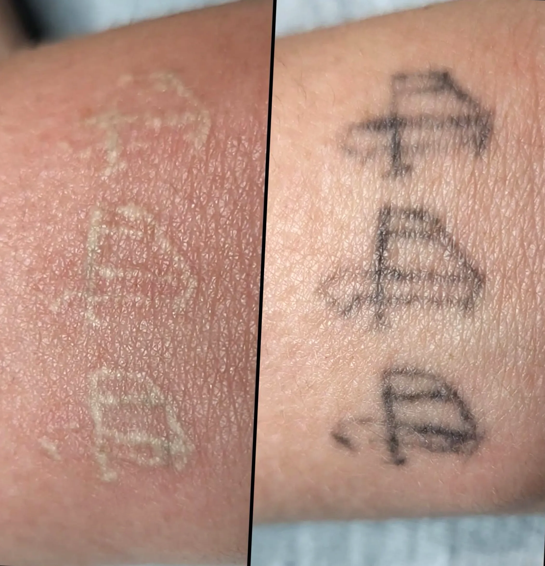 saline tattoo removal