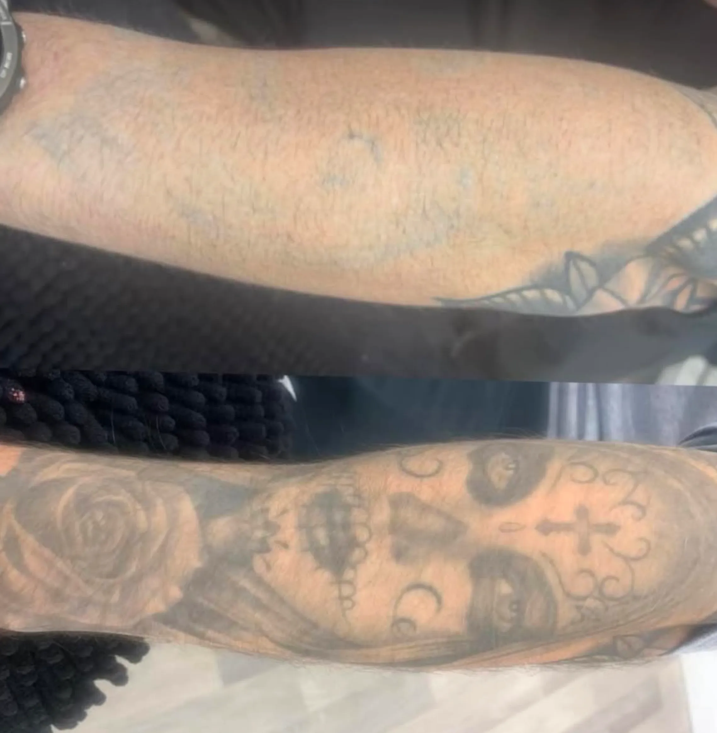 temporary tattoo removal