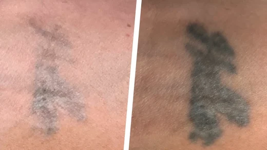 does nail polish remover remove tattoos